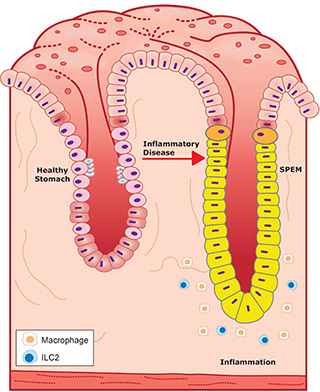 graphic depicting stomach inflammation